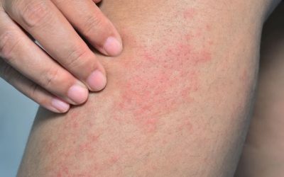 El Sarpullido por Estrés y su Relación con la Piel: Cuando el Cuerpo Habla